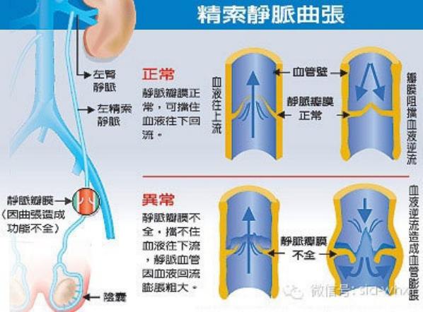 關(guān)于2021年征兵精索靜脈曲張標(biāo)準(zhǔn)的探討，2021年征兵精索靜脈曲張標(biāo)準(zhǔn)深度解析