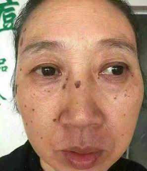 去老年斑的簡單方法，重拾肌膚光彩的秘訣，去老年斑秘籍，重拾肌膚光彩的簡易方法
