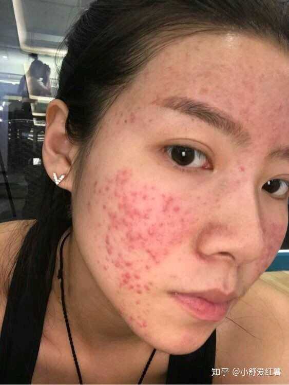 如何有效去除臉上的痘印——全方位指南，全方位指南，如何有效去除臉上痘印的方法