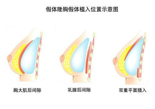 怎么樣才能豐胸最有效最安全，最安全有效的豐胸方法探究