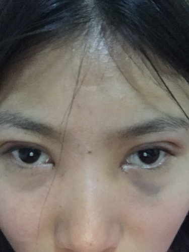 關(guān)于開眼角與割雙眼皮手術(shù)費用解析，究竟需要多少錢？，開眼角與割雙眼皮手術(shù)費用全解析，究竟要花多少錢？