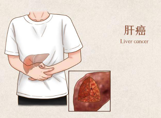 肝癌一般三處痛，癥狀解析與應(yīng)對策略，肝癌癥狀解析，疼痛位置、應(yīng)對策略及三處痛詳解