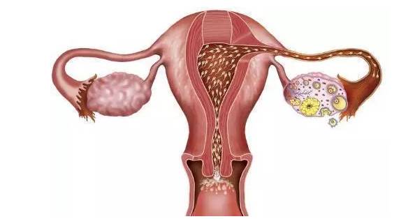 小姑娘為什么會(huì)得卵巢囊腫，小姑娘患卵巢囊腫的原因分析