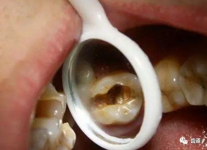 如何判斷牙齒牙洞已經(jīng)深入到牙髓？，牙齒牙洞深度判斷，如何確定已影響牙髓？