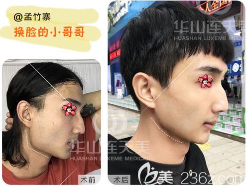 削顴骨手術(shù)費(fèi)用詳解，手術(shù)費(fèi)用大概要多少錢？，削顴骨手術(shù)費(fèi)用詳解，手術(shù)費(fèi)用及預(yù)算指南