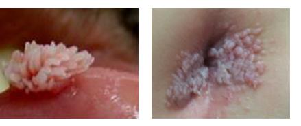 女性尖銳的病圖片，了解、預(yù)防與應(yīng)對，女性尖銳濕疣，圖片解析、預(yù)防與應(yīng)對策略