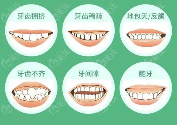 牙齒正畸費(fèi)用詳解，一般多少？，牙齒正畸費(fèi)用全面解析，了解一般價(jià)格及影響因素