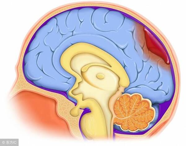 腦出血后遺癥有哪些，腦出血后遺癥的類(lèi)型與表現(xiàn)