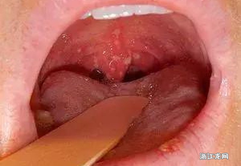 皰疹性咽峽炎五個(gè)分期詳解，皰疹性咽峽炎的五個(gè)分期詳解及特點(diǎn)解析