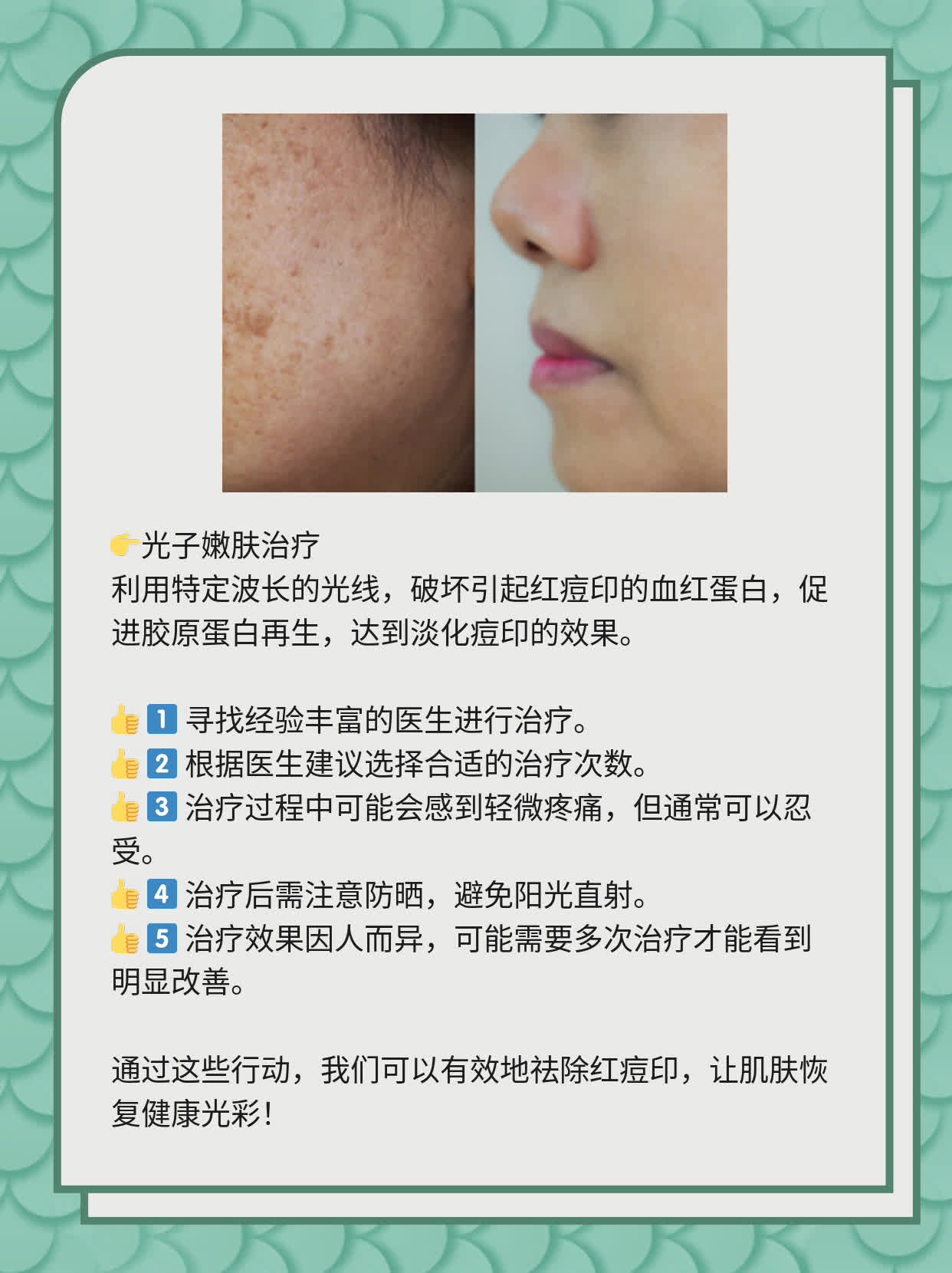 如何有效去除紅痘印，一站式解決方案，一站式解決紅痘印問題，有效去除方法大全