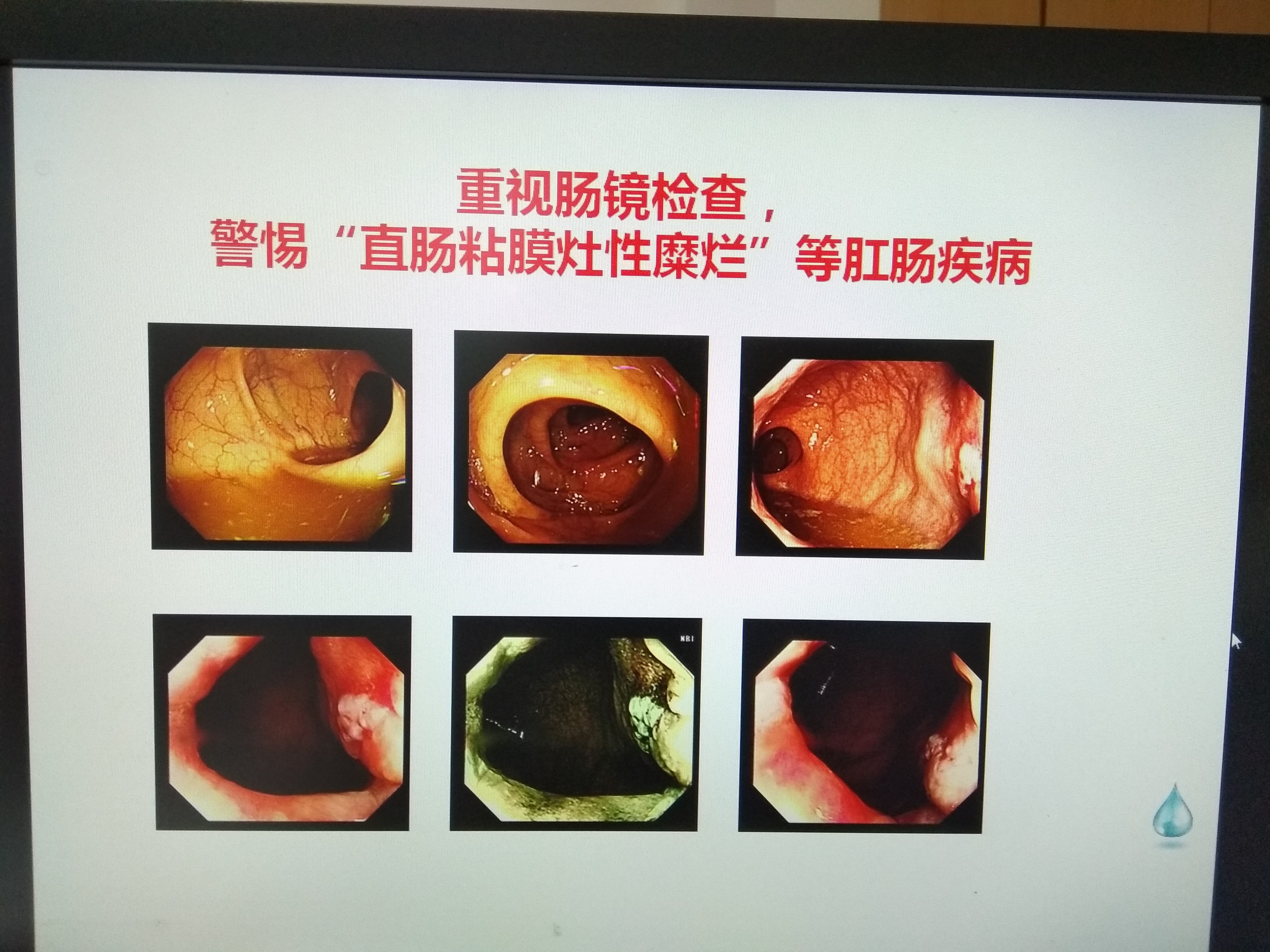 腸鏡檢查，一次不愉快的經(jīng)歷，腸鏡檢查，一次難忘的不愉快體驗(yàn)